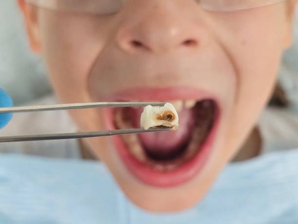 Best Emergency Wisdom Teeth Removal in Palisade, CO